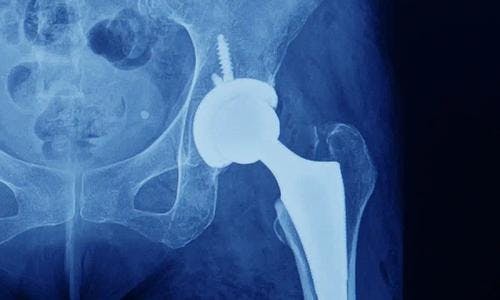 The possibility of the 'day-case' hip replacement