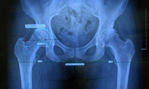 The cutting edge of hip replacement surgery